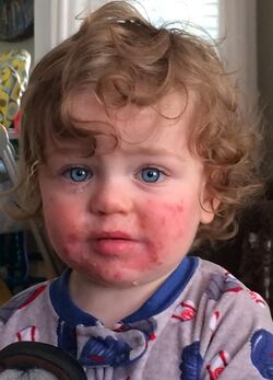 14 month old with Fifth Disease.jpg