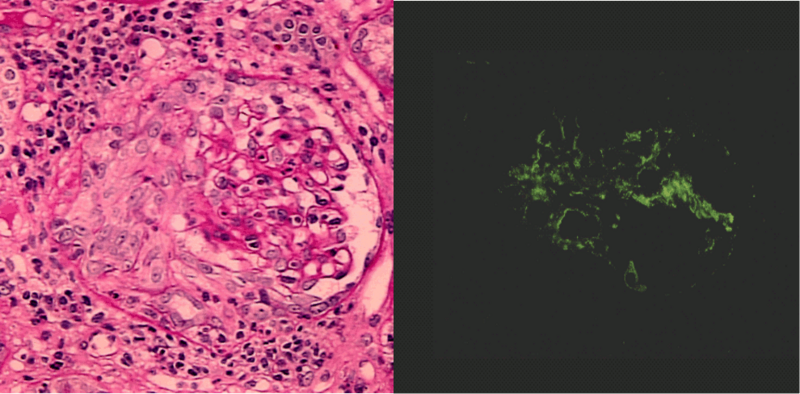 File:Crescentic glomerulonephritis PAS and IF.png