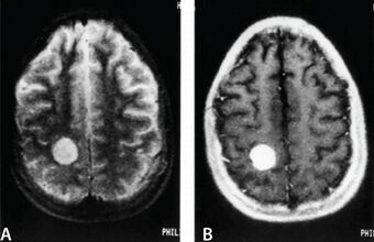 Metastatic angiosarcoma in the brain.jpg