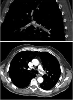 Pulmonary embolism CTPA.JPEG