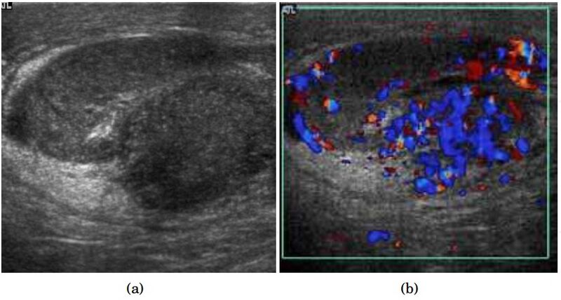 File:Scrotal ultrasonography of epididymo-orchitis.jpg