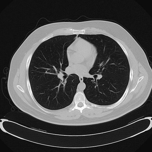 File:CT-Thorax-5.0-B70f-Lungs.jpg