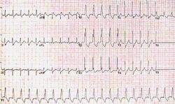 Cardiogram indicating right bundle branch block with tachycardia.jpg