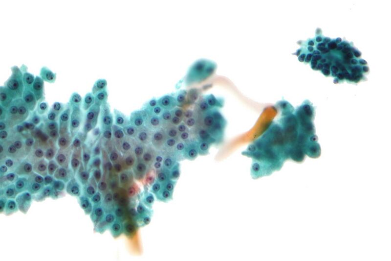 File:Fibrocystic changes of breast - cytology 1.jpg
