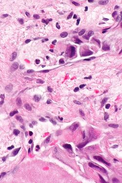 Laryngeal squamous carcinoma - LVI -- very high mag.jpg