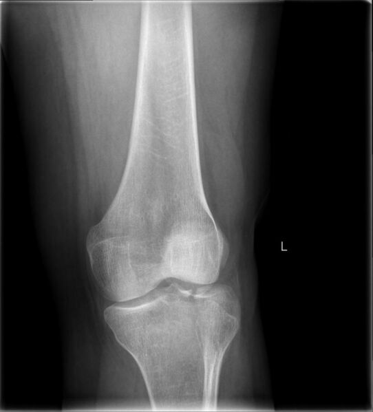 File:Lateral Tibial Plateau fracture XRay with Depression.jpg