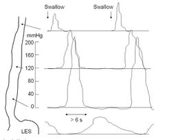 Nutcracker manometry.jpg