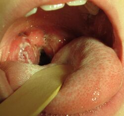 Strep throat2010.JPG