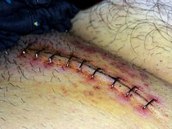 Surgical staples3.jpg