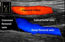 Ultrasonography of deep vein thrombosis of the femoral vein -annotated.jpg