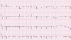 Wandering atrial pacemaker.png