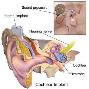 Blausen 0244 CochlearImplant 01.png