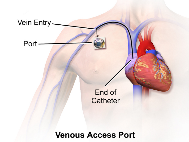 File:Venous Access Port Catheter.png