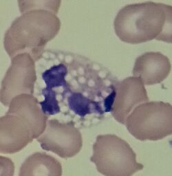 A vacuolated neutrophil