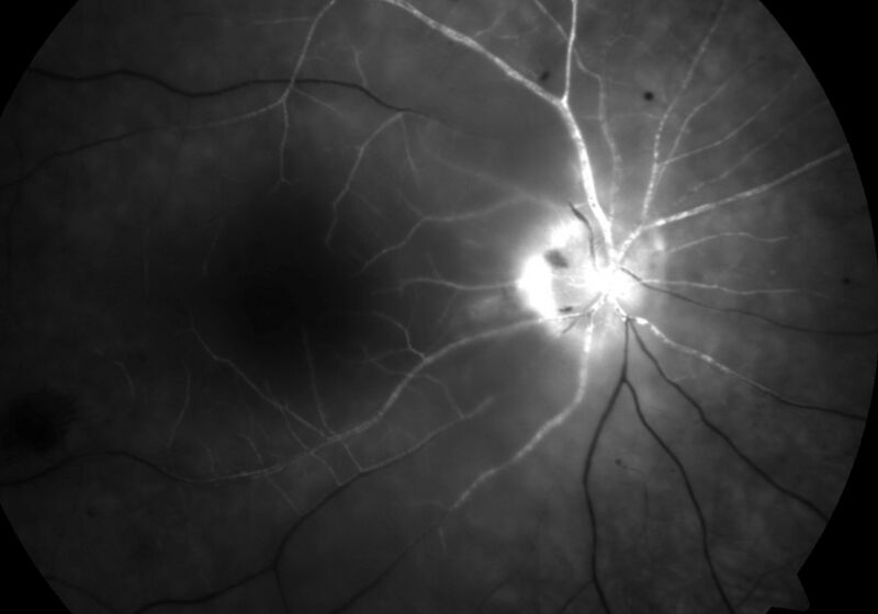 File:Fluorescein angiogram of patient with central retinal artery occlusion (CRAO).jpg