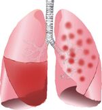 Lobar Pneumonia and bronchopneumonia illustrated.jpg