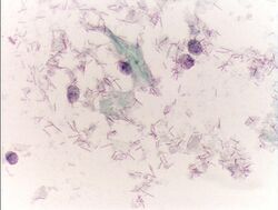 Pap test citolysis.JPG