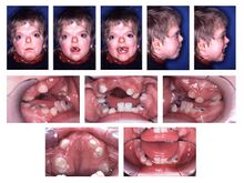 Patient with Apert (ACS Type I) syndrome