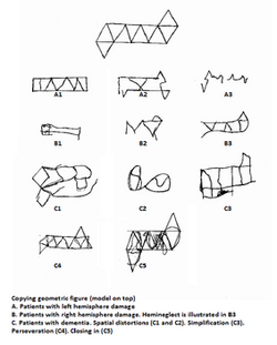 Re-created geometric drawings from patients with left and right hemisphere damage, hemineglect, and dementia.png