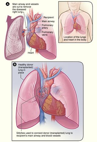 Lung transplant.jpg