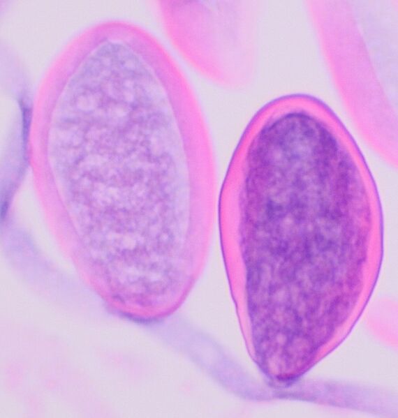 File:Histopathology of enterobius vermicularis eggs, HE stain.jpg