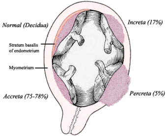 Placenta accreta.png