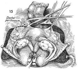 Radical hysterectomy.jpg