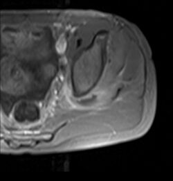 Axial T1 FS Post Gad tropical pyomyositis.JPG