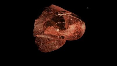 Tumor in the breast visualized by Breast-CT