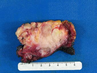 Desmoid-type fibromatosis.gross pathology.jpg