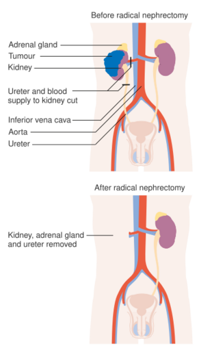 Diagram showing before and after a radical nephrectomy CRUK 104.svg