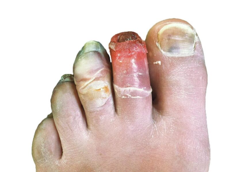 File:Human toes, 12 days post-frostbite.jpg