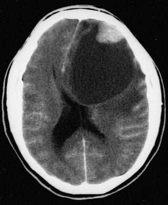 An image of a brain with pleomorphic xanthoastrocytoma
