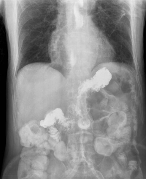 File:Gastroesophageal reflux barium X-ray.jpg