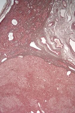 Hepatic adenoma low mag reticulin.jpg