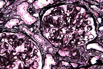 Membranous nephropathy - mpas - very high mag.jpg
