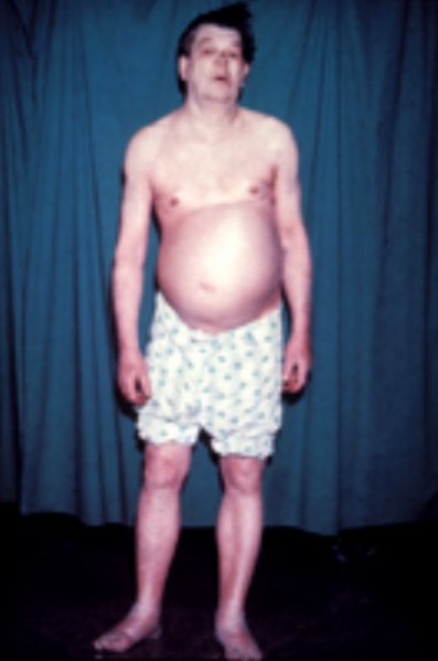 File:Myxedema standing.png
