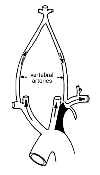 File:The promixal part of left subclavian is blocked on left side so no flow in vertebral and to left arm-blood from right vertebral enters left vertebral and flows back to supply left arm 2013-07-05 17-11.jpg