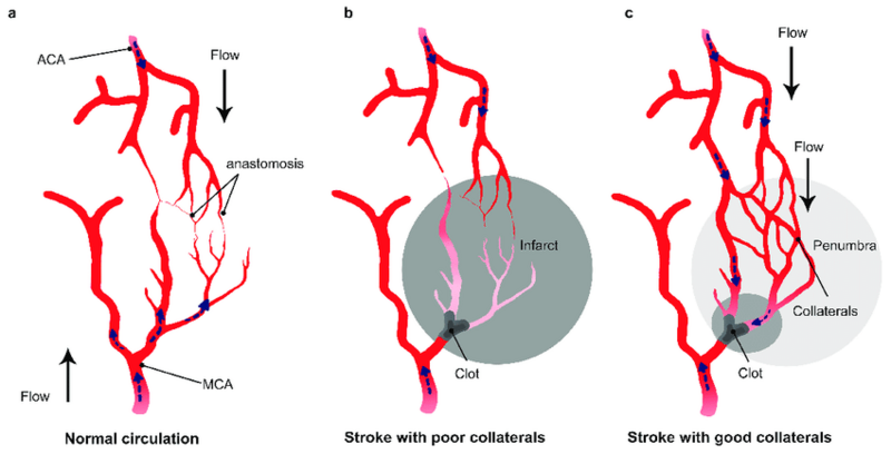 File:Impact of collateral flow on clot lysis and reperfusion. (a) Schematic drawing of the collateral network showing anastomoses between the middle cerebral artery (MCA) and anterior cerebral artery.png