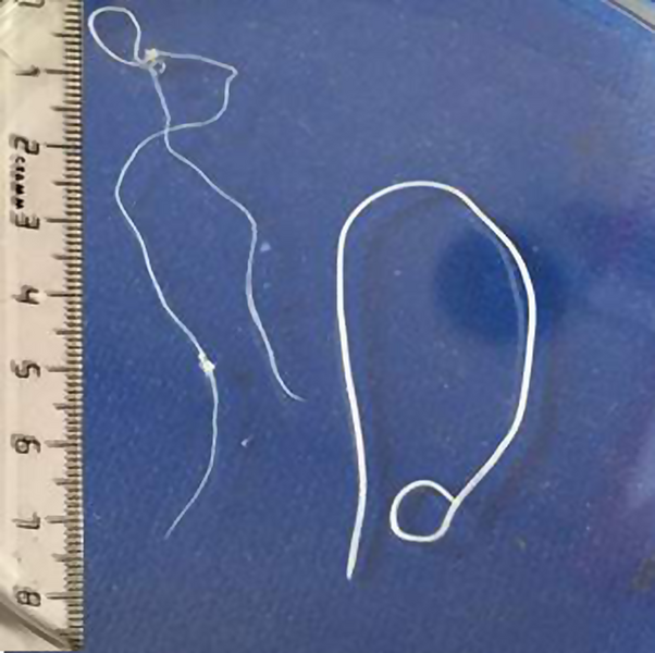 File:Parasite160032-fig1 - Dirofilaria immitis (left) in a child from the Russian Federation, and Dirofilaria repens (right).png