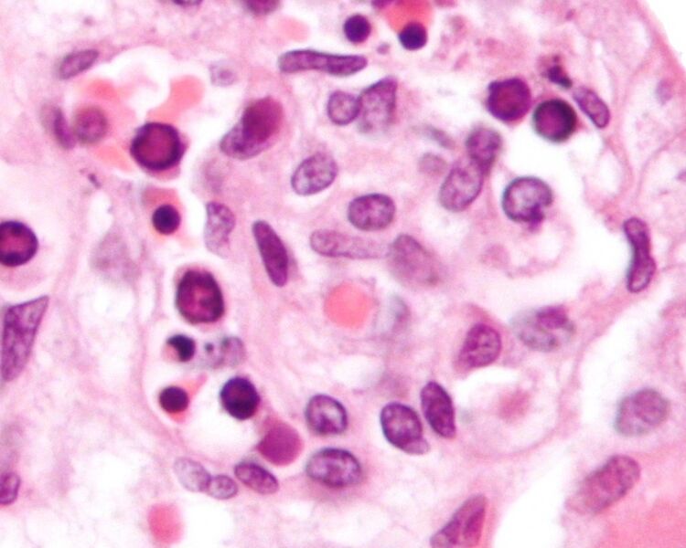 File:Parvovirus infection - cropped 2 - very high mag.jpg