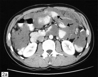 Pseudomyxoma.jpg