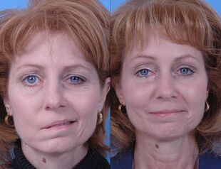 Before and after dynamic smile reconstruction.jpg
