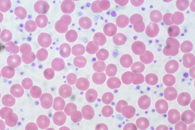 File:Essential Thrombocythemia, Peripheral Blood (10189570483).jpg