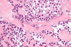 Hyalinizing clear cell carcinoma - very high mag.jpg