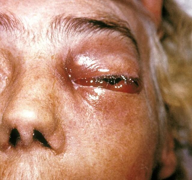 File:Periorbital fungal infection known as mucormycosis, or phycomycosis PHIL 2831 lores.jpg
