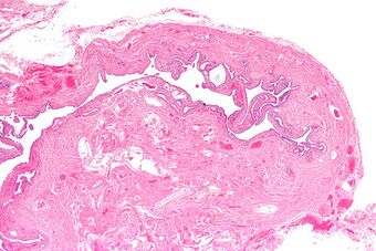 Salpingitis isthmica nodosa - very low mag.jpg