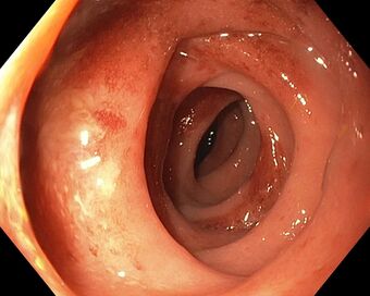 Segmental colitis associated with diverticulosis.jpg