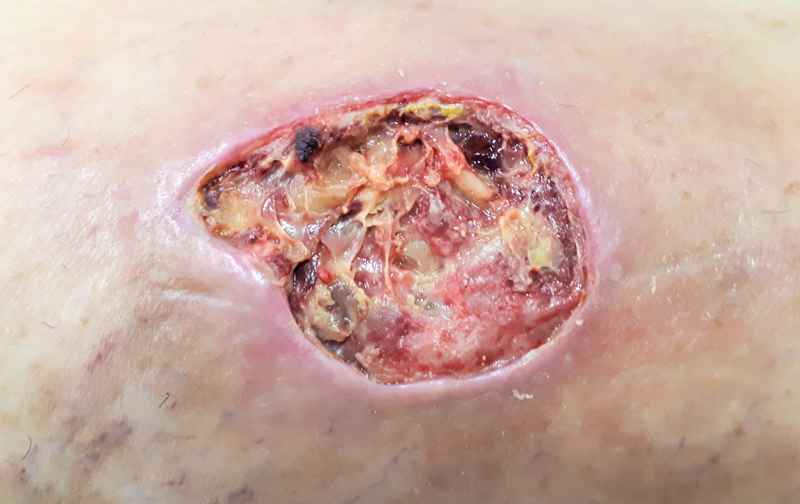 File:Úlcera varicosa (RPS 24-08-2020) en pierna con insuficiencia venosa crónica.png