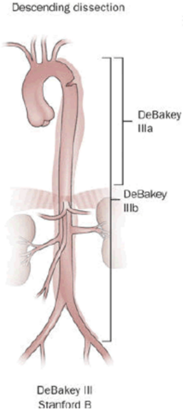 File:Aortic dissection of DeBakey type III.png